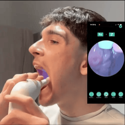 AURYX Tonsil Stone Remover with Camera